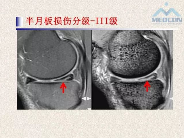 半月板位置在哪儿图