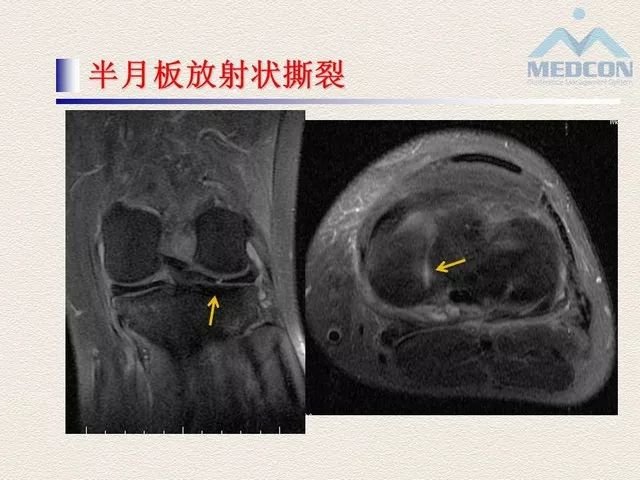 半月板常见病变及正常变异的磁共振诊断 | 影像天地