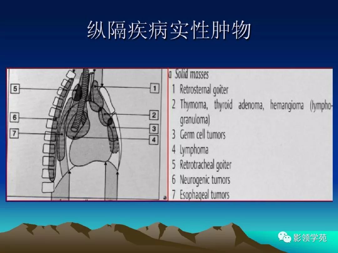 纵隔肿瘤影像诊断