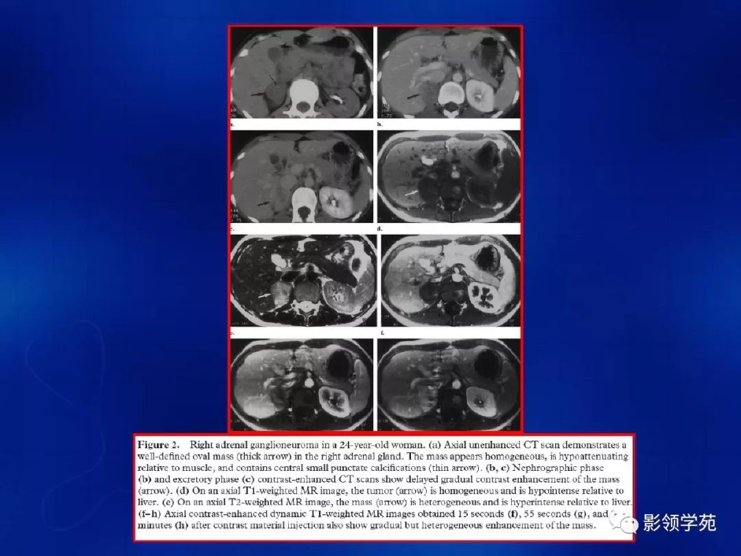 肾上腺肿瘤及瘤样病变的影像诊断