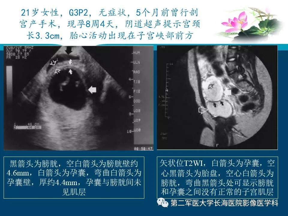 剖宫产瘢痕妊娠的mri表现