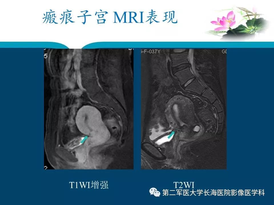 剖宫产瘢痕妊娠的mri表现