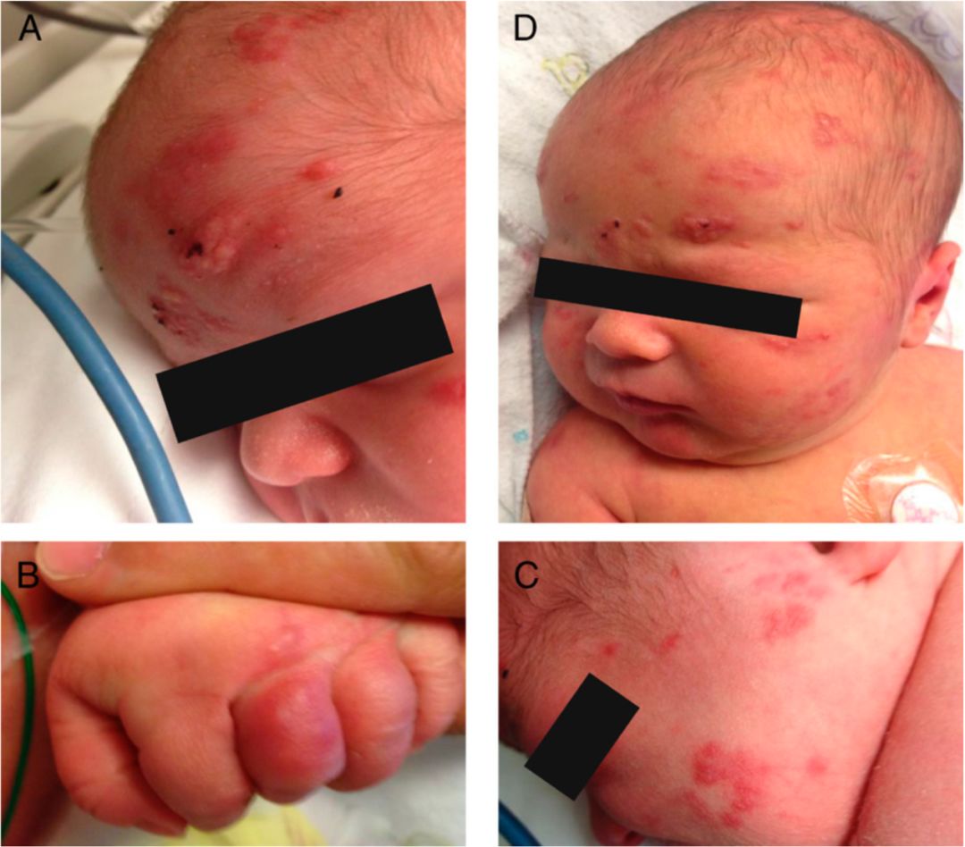 一个足月正常胎龄男婴,自然分娩出生时全身皮疹,为弥漫分布的红色斑