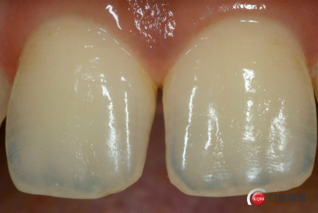 有的牙齿釉质层很薄,可以看到明显的乳光和发育叶.