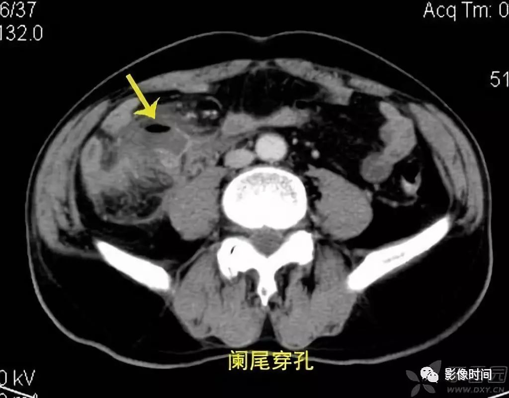 急性阑尾炎ct诊断