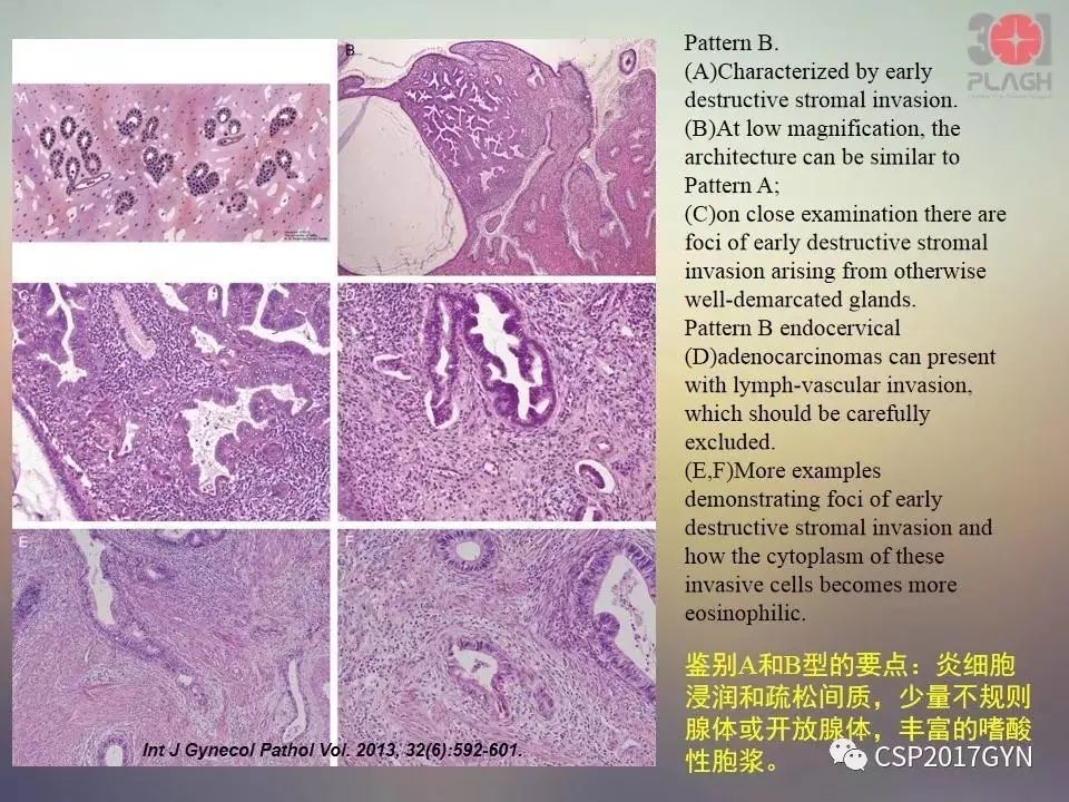 宫颈腺癌的临床病理研究进展