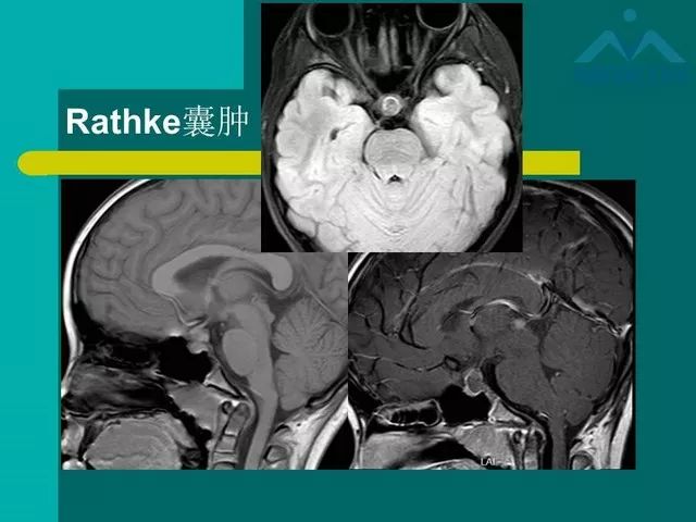 儿童rathke裂囊肿的影像与临床 | 影像天地