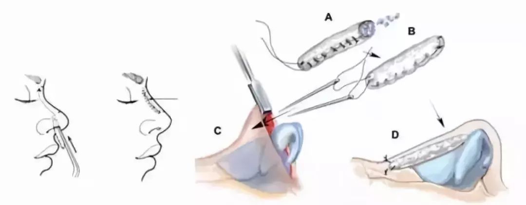 一般常用耳软骨进行鼻尖塑形,鼻中隔软骨抬升鼻小柱,而隆鼻常用 肋