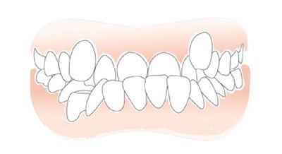 宝宝牙齿不整齐怎么办