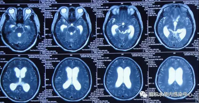 脑囊虫性脑积水患者两次术后病情加重航空总医院陈红伟将他治愈