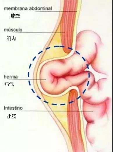 朱仁武医师表示,疝气,即人体内某个脏器或组织离开其正常解剖位置