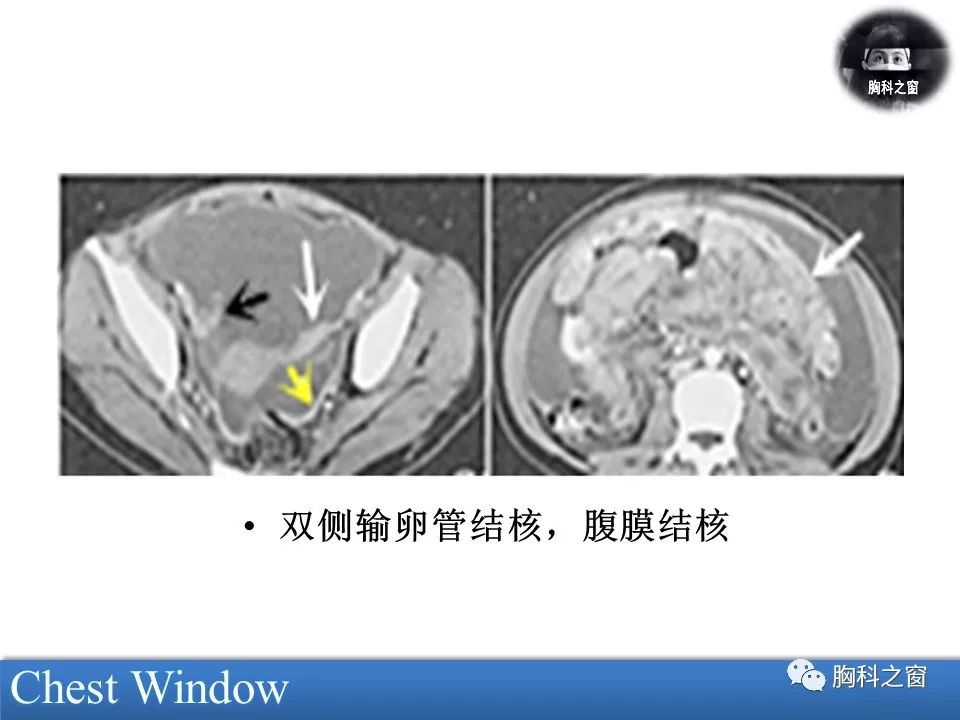 腹部结核的影像学诊断