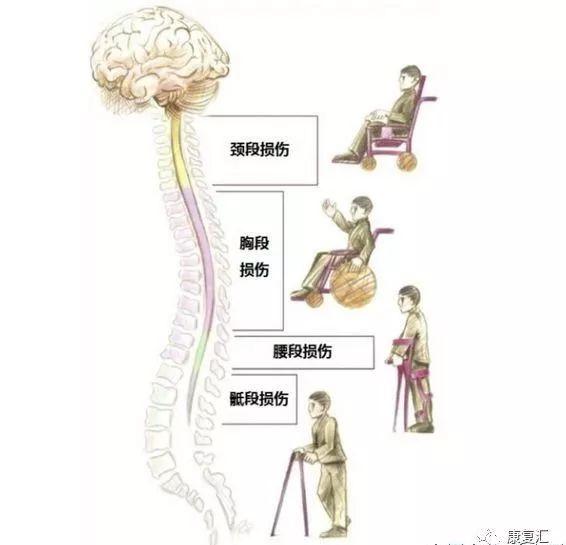 脊髓损伤的康复