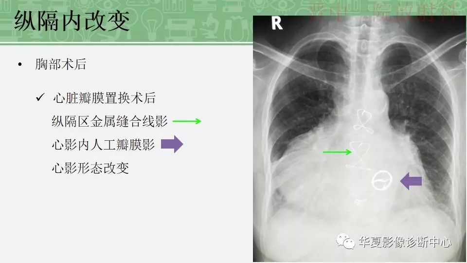 胸部常见疾病x线表现