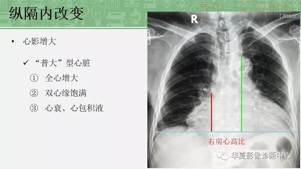 胸部常见疾病x线表现