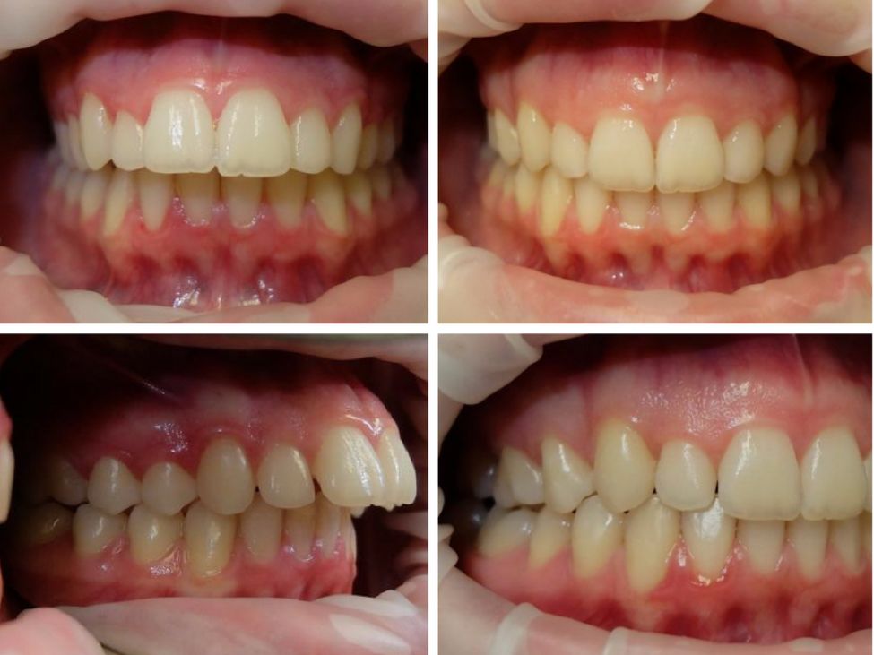 凸嘴 这个是我们常说的龅牙(天包地),除了上排牙突出之外其他牙齿也很