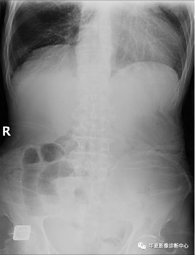 肠梗阻x线表现