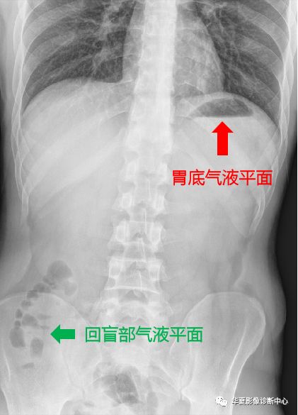 回肠末段及结肠十二指肠球部(灯泡样)胃底腹部常见的正常气-液平面