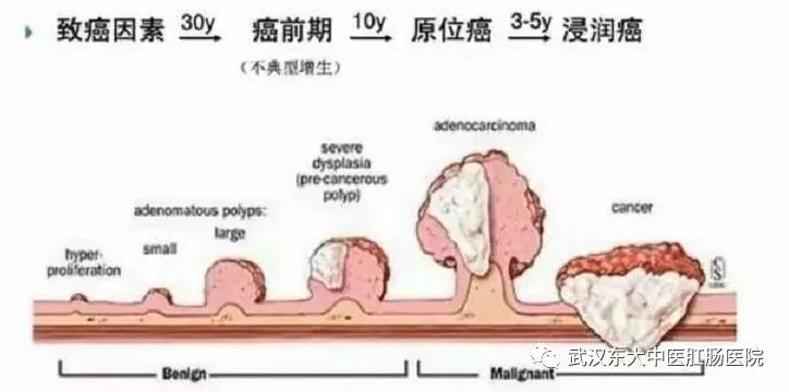 结肠息肉30年左右演变为癌前病变,5-10年演变为癌症,后浸润,转移