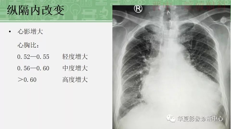 胸部常见疾病x线表现