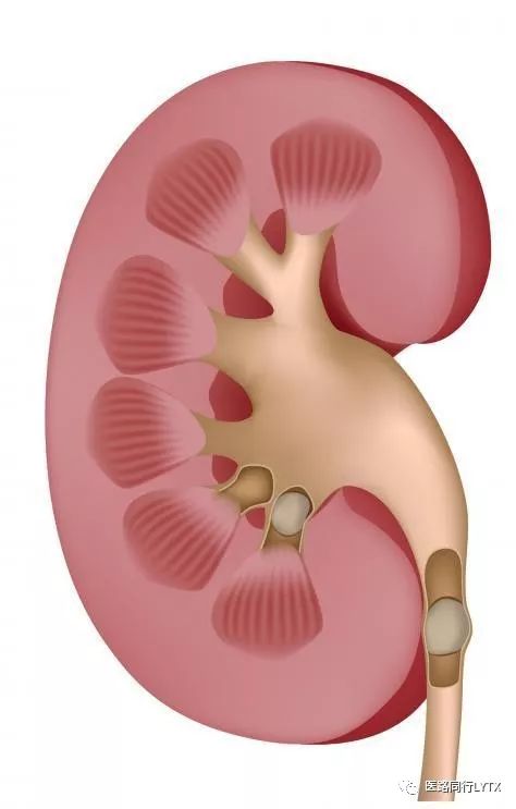 输尿管结石的危害及预防