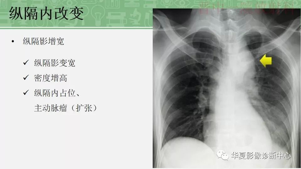 胸部常见疾病x线表现