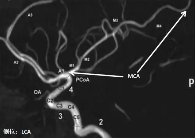 大脑中动脉分段与分支