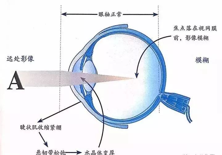 儿童出现假性近视时,眼睛若能适当休息或点用睫状肌松弛剂(散瞳剂)