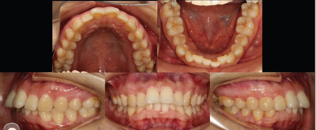 隐形矫治十强病例丨拔除前磨牙,矫正双牙列前突伴深覆