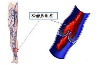 手术后小腿血栓怎么办