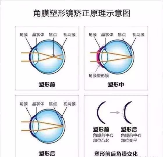 什么是角膜塑形镜?