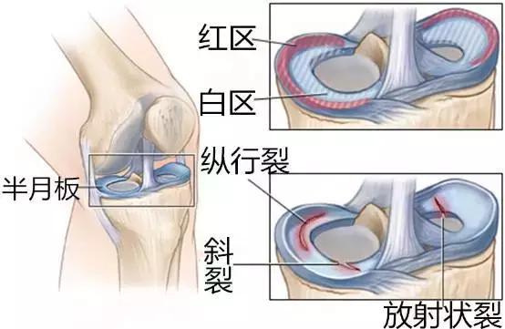 半月板手术后遗症