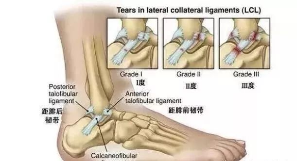 由于患者背屈跖屈,以及跖屈内翻活动受限.