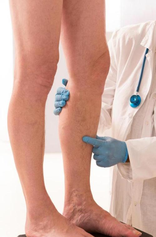 小腿静脉血栓是什么原因造成的该如何预防和治疗