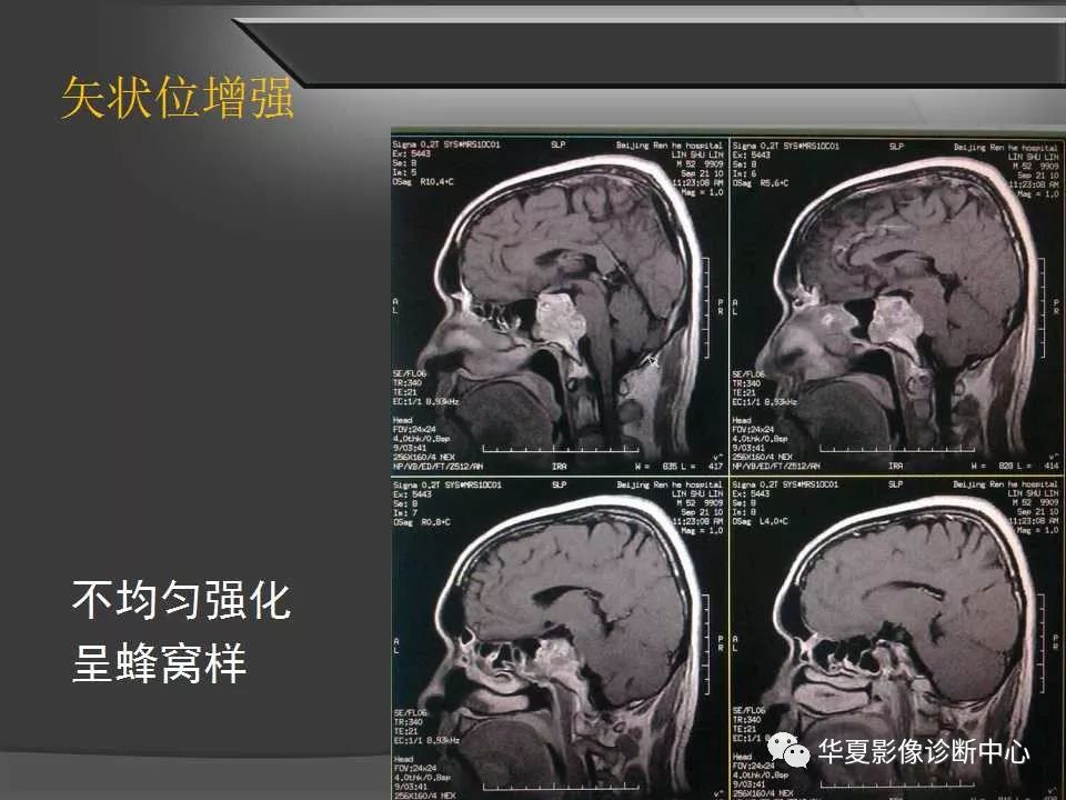 斜坡解剖及常见肿瘤影像表现