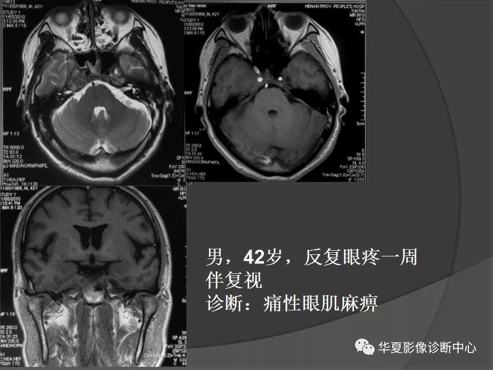 斜坡解剖及常见肿瘤影像表现