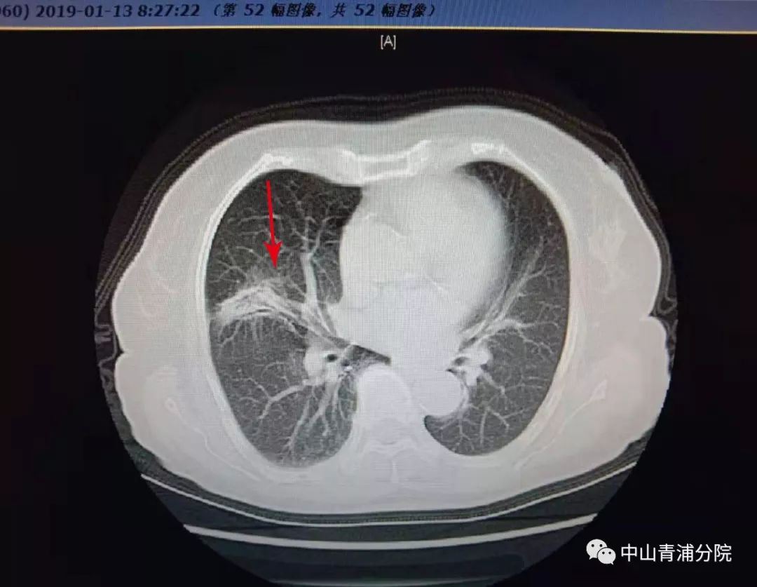 (入院时抗感染治疗前胸部ct片)