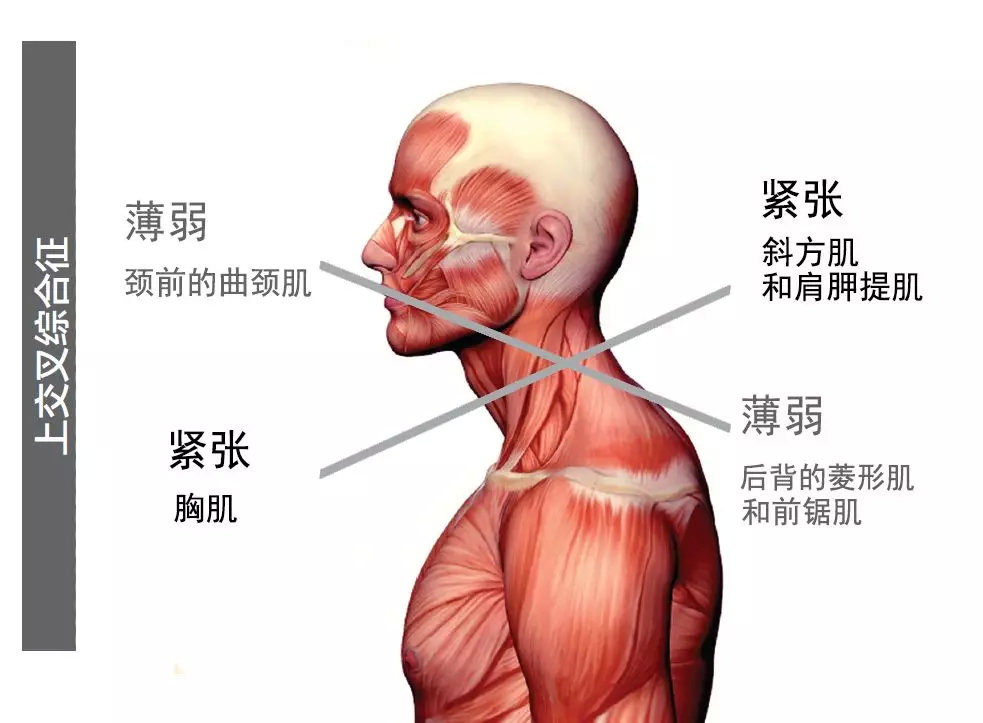 久坐引发疾病,圆肩驼背上下交叉综合征怎么办?