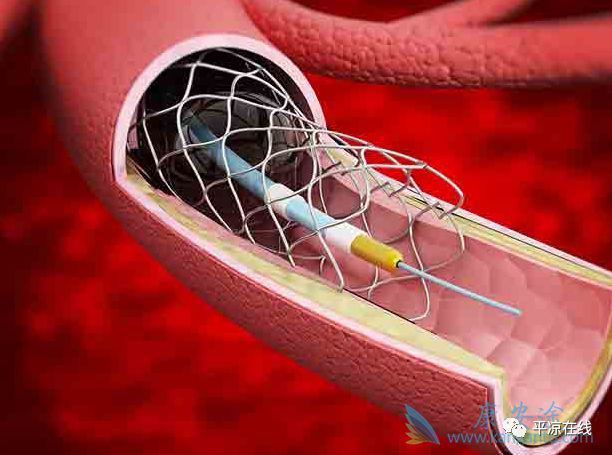 但心脏支架手术并不能"一劳永逸", 支架的再狭窄几率在临床中较高
