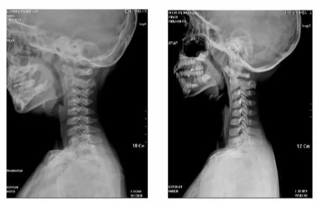 这些迹象表明孩子颈椎出了问题,必须要注意了!