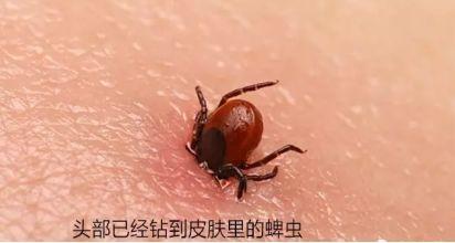 蜱虫叮咬后,如果处理不当,蜱虫的口器会留在皮肤内