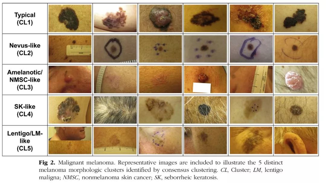 400张黑色素瘤图像的组合聚类分析得出5种形态组:典型,痣样,无色素性