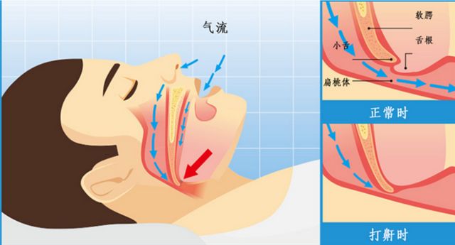 打鼾的原理是什么_打鼾是什么原因导致的(3)