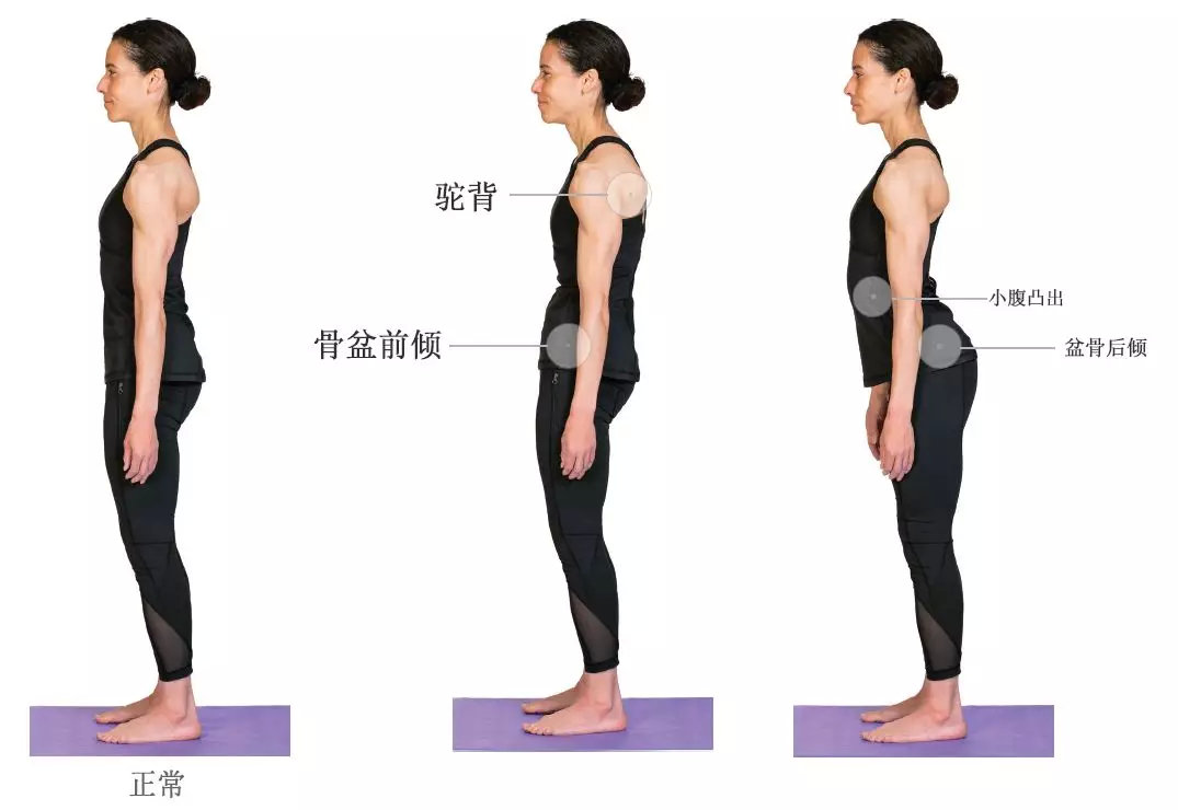 腰椎过度前屈,骨盆前倾,小腹凸出,臀部后倾下垂,可以将这些统称为