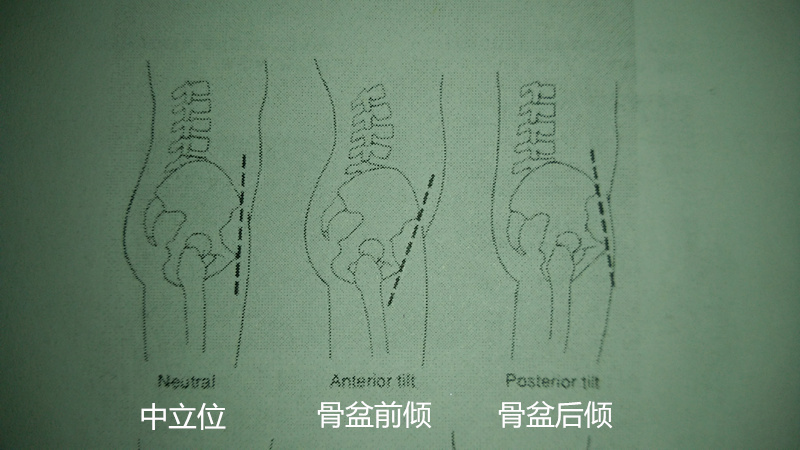 大腿粗,可能不是遗传,有可能是你骨盆前倾导致