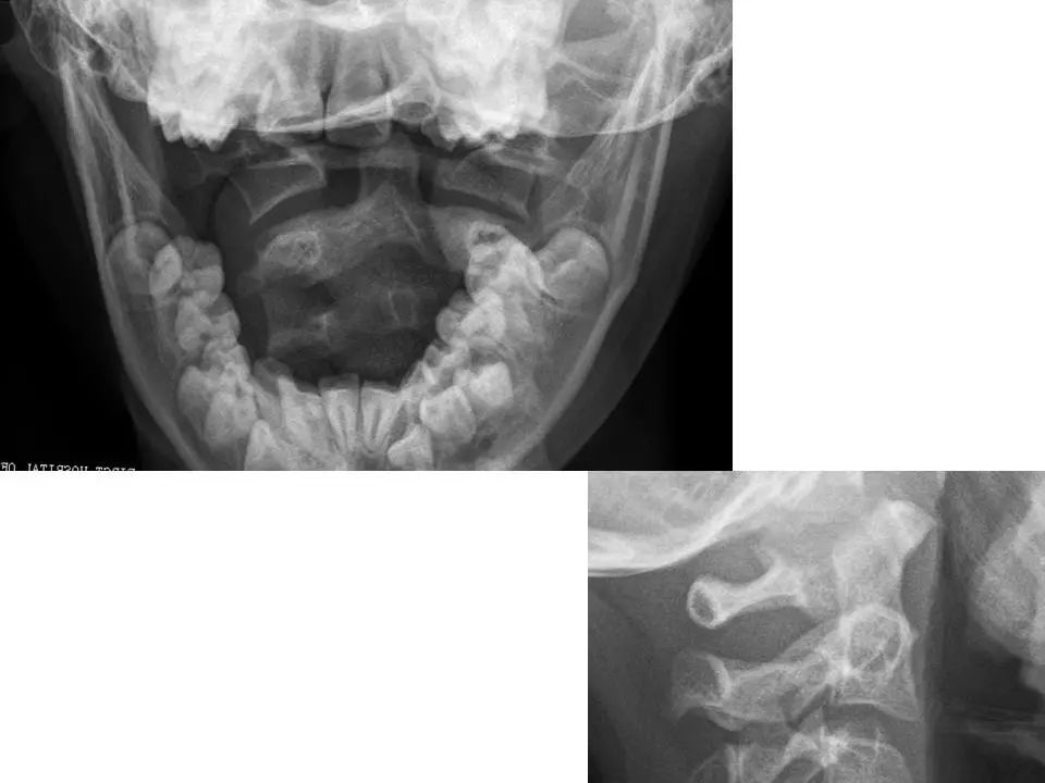寰枢关节脱位的影像诊断