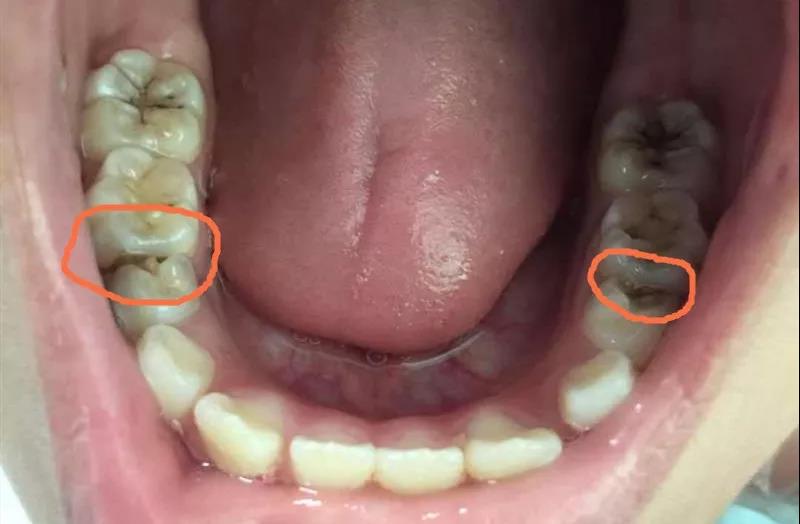 3岁以上的孩子可以通过门诊每3-6月一次的口腔涂氟来预防龋齿,若孩子