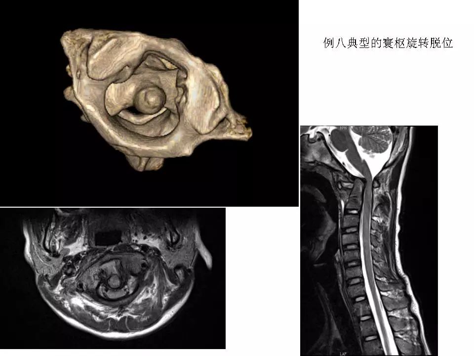 寰枢关节脱位的影像诊断