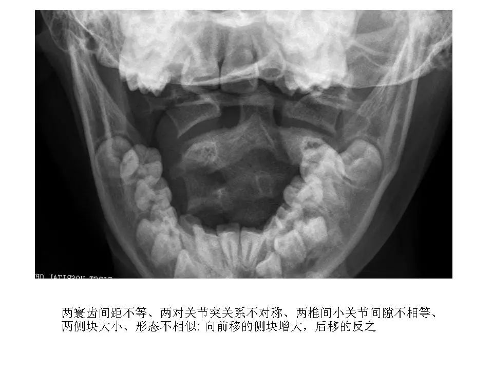 寰枢关节脱位的影像诊断