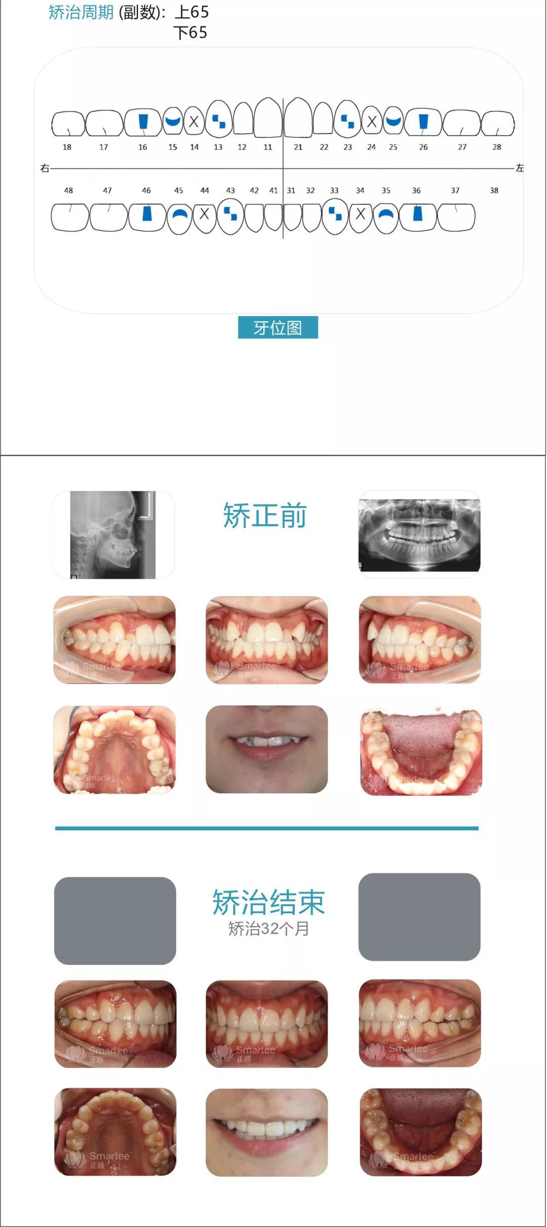 2mm结扎丝结扎.解除反(牙合),后期磨牙少量前移,关闭间隙.